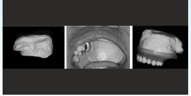 Maxillary obturator designed in PEEK