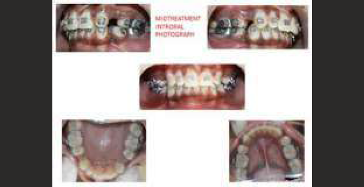Mid-treatment photograph with extraction