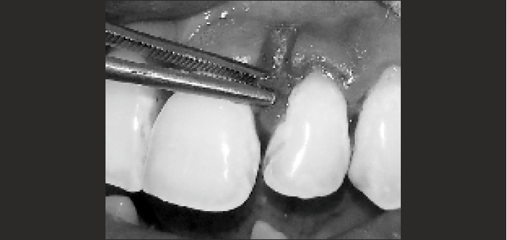 Partial thickness flap elevated.