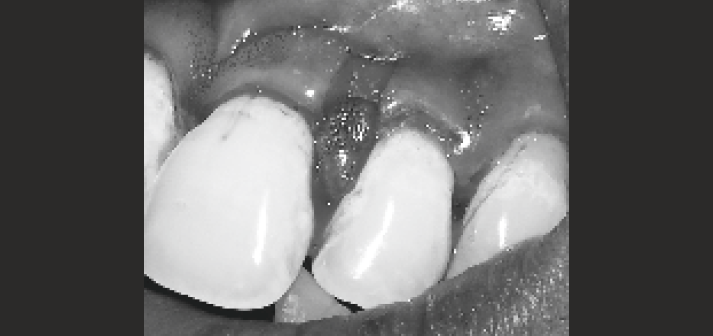 Flap reconstructed on desired position.