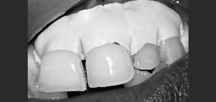 Periodontal dressing done.