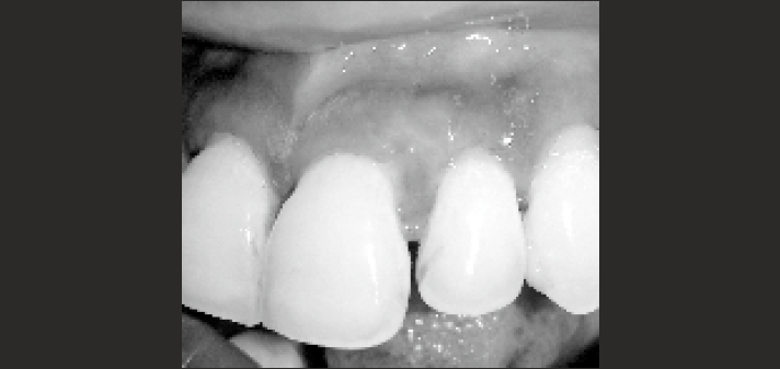 1 Month postoperative view.