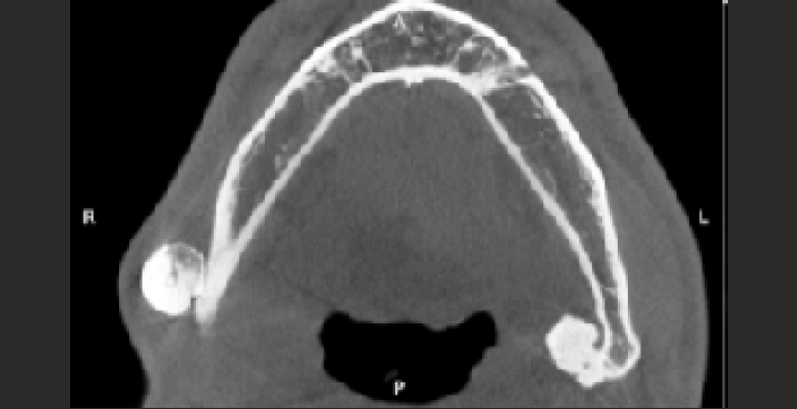 Axial CBCT Image