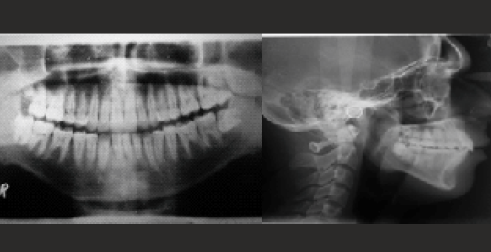 Post-treatment radiographs