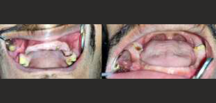 Partially edentulous maxillary & mandibular edentulous ridge