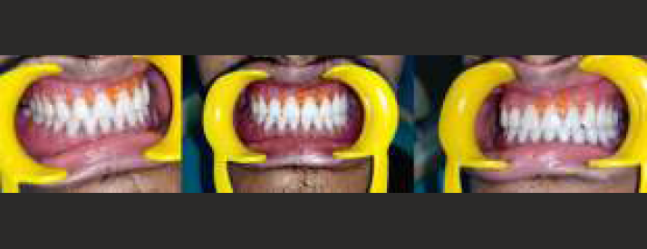 Maxillary Cu-sil overdenture & Mandibular overdenture - in patient's mouth