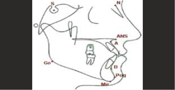 Cephalometric tracing with landmarks S- Sella, N- Nasion, ANS- Anterior Nasal spine, Pt A, Pt B. Pog- Pogonion, Go-Gonion, Me- Menton. Gn- Gnathion, Co - Condylion