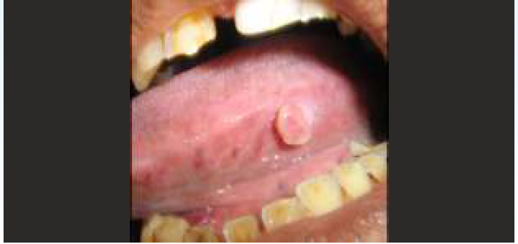 irritational fibroma present on the left lateral border of tongue