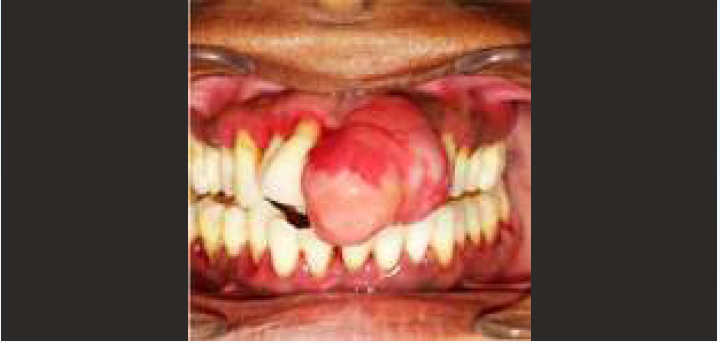 pyogenic granuloma present in maxillary ant. Region of gingiva in relation with 11,21,22