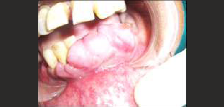 peripheral giant cell granuloma present on mandibular anterior region of gingiva in relation to 31, 32,33,34,35,