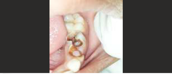 Pulp polyp related with carious primary first mandibular molar.