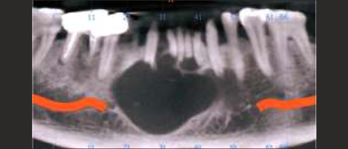 CBCT View showing well -defined hypo-density in relation with 44, 43, 42, 41, 31, 32, 33 and 34.