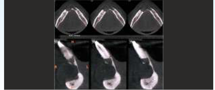 Axial section and oblique coronal section of CBCT showing well-defined hypo-density with labial plate perforation.