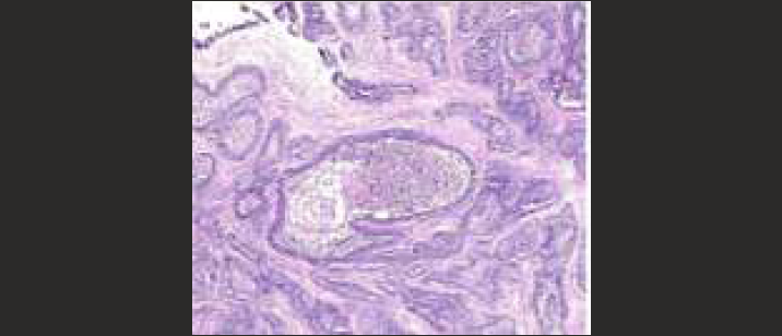Histopathological view showing solid epithelial nests with peripheral palisading ameloblastic cells and central squamous metaplasia
