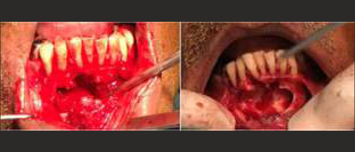 Enucleation of the lesion with removal of 1 to 2mm of bone