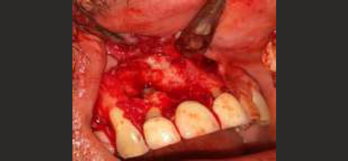 Enucleation with Apicectomy