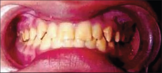Autosomal dominant inheritance with smooth hypoplastic amelogenesis imperfecta (AI).