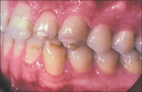 Environmental enamel hypoplasia.