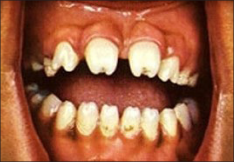 Hutchinson’s teeth.