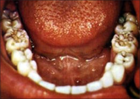 Mulberry molars.