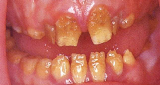 Enamel hypoplasia due to vitamin D deficit.