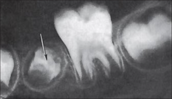 Turner’s tooth-defect in quality and thickness of the enamel (black arrow) Radiographic image.