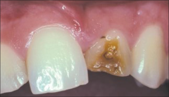 Turner’s hypoplasia - Clinical Image.