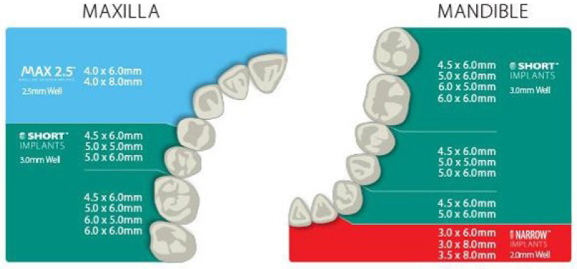Implant size chart.