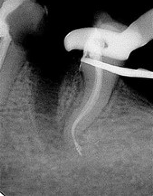 Radiograph after removal of mesial root with regards to 36