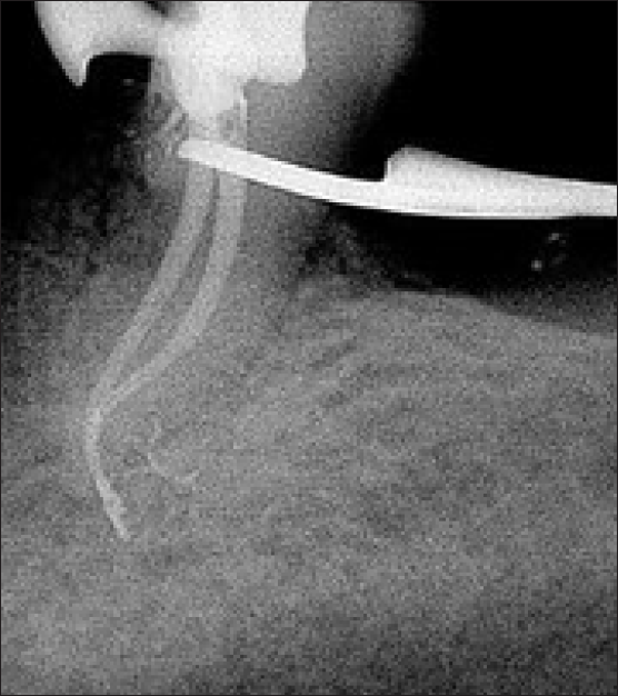 Obturation radiograph of distal root with regards to 36