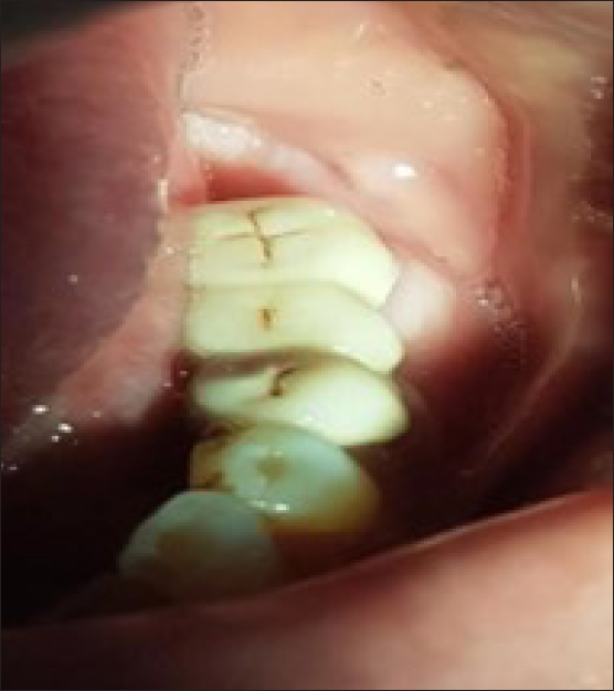 Post-operative photograph after luting of prosthesis