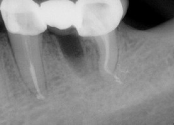 Post-operative radiograph