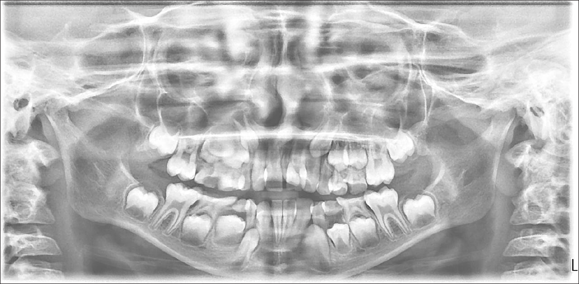 Orthopantomogram (OPG) of the patient showing impacted and erupted mesiodens in maxillary anterior region.