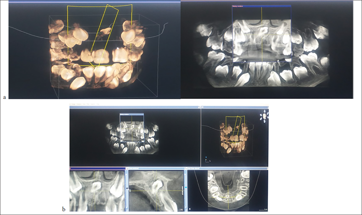Cone beam computed tomography (CBCT) images showing impacted mesiodens close to the nasal floor.