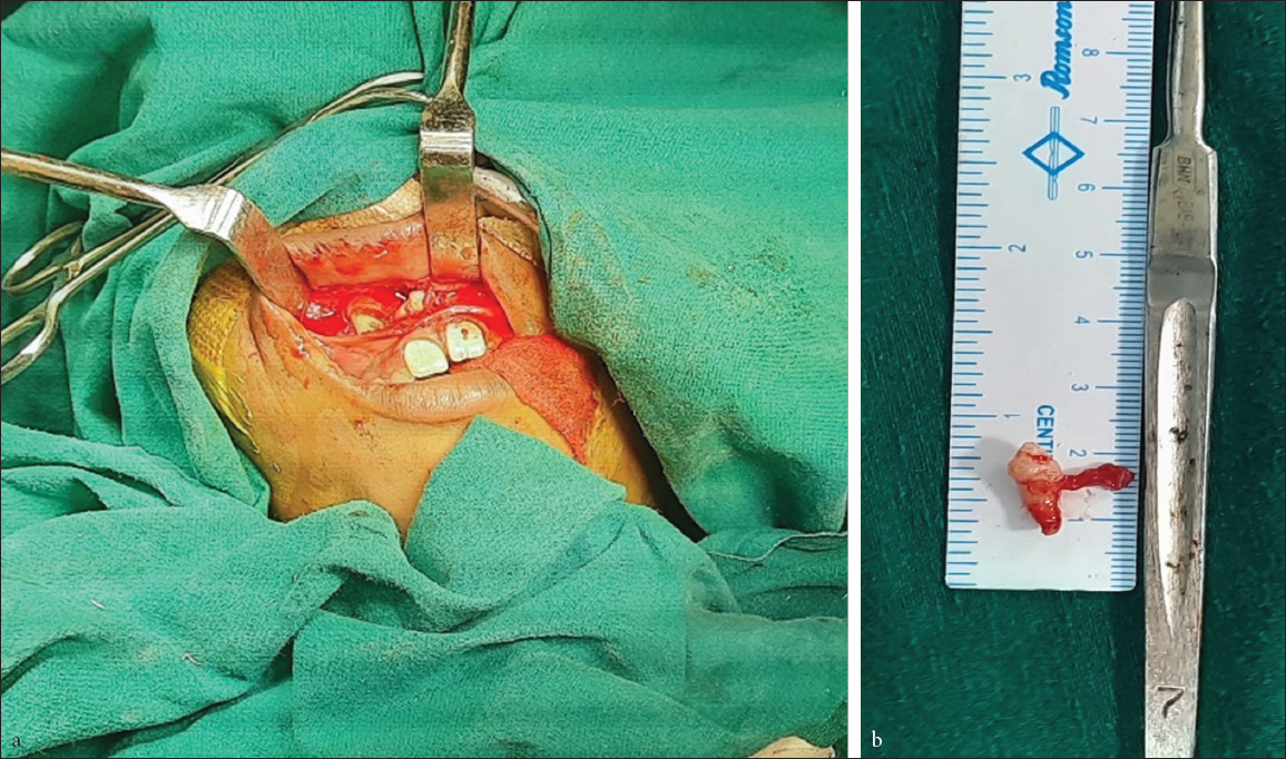 a) Surgically extracted impacted mesiodens under general anesthesia; b) Mesiodens removed