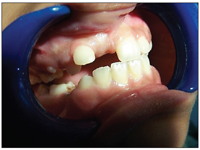 Pre-operative photograph showing the impacted of the maxillary right central incisor.