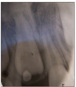 Intraoral Periapical Radiograph (IOPAR) showing impacted the maxillary right central incisor with 1 impacted supernumerary tooth on it.