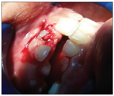 Extraction of supernumerary teeth.