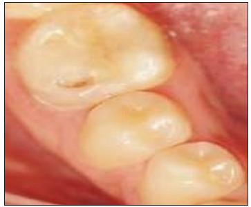 Tooth no. 36 with fractured composite restoration buccally. Buccal view.