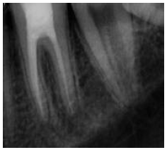 Immediate post-treatment periapical obturation radiograph, showing confluence of the Middle mesial canal with the mesio-lingual canal and after cementation of the indirect composite onlay.