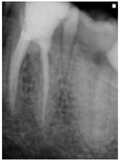 Post-obturation periapical radiograph after 2-year’s follow-up showing healing of the periodontal tissues and intact coronal restoration.