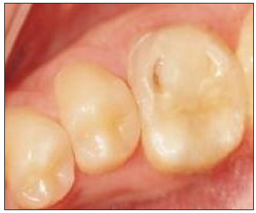 Tooth no. 36 with fractured composite restoration buccally. Occlusal view.