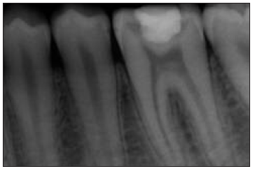 Pre-operative periapical radiograph showing large restoration (Composite) close to the mesial pulp horn in 36.