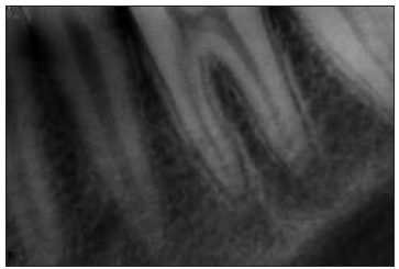 Periapical pre-operative radiograph showing widening of the periodontal ligament on both root of 36.