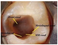 Access cavity showing the location of the middle mesial canal in the center of the groove, between the Mesiobuccal and distobuccal canal.