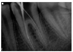 Working length radiograph showing confluence of the middle mesial canal (MMC) with the Mesiolingual canal.