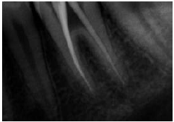 Master cone radiograph showing confluence of the middle mesial canal (MMC) with the Mesiolingual canal.