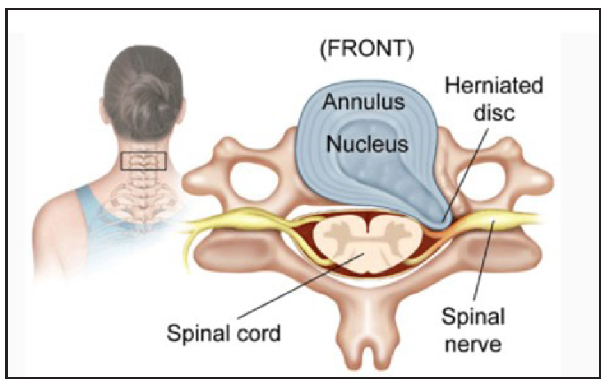 Herniated disk in the cervical spine.