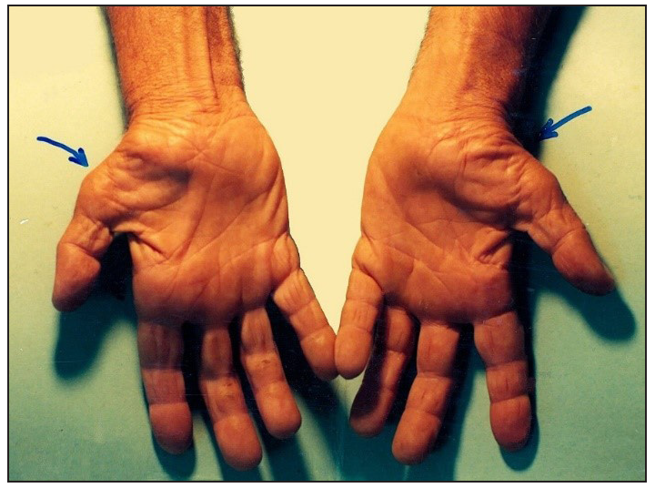 Blue arrows in the image shows muscular atrophy of carpal tunnel and wrist area in carpal tunnel syndrome.