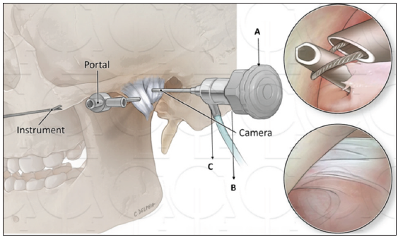 A: 1.9-mm arthroscope with C-mount attachment, B: focusing ring, and C: light source attachment.